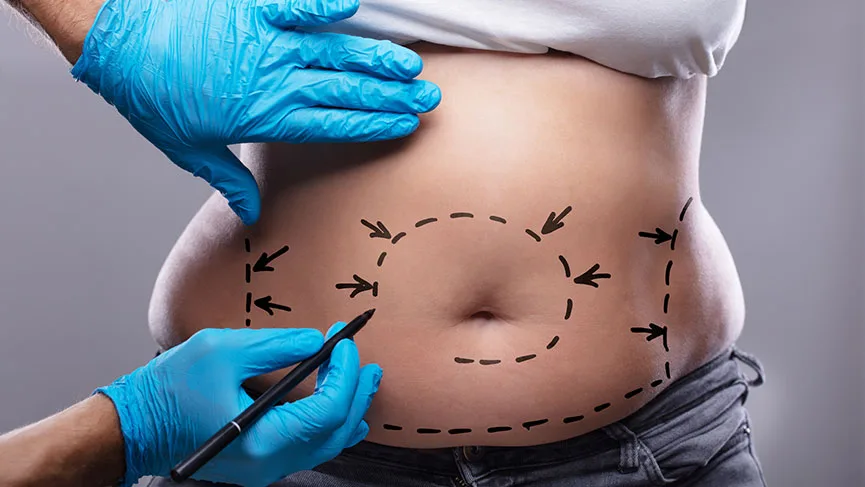Liposuction Sonrası Cilt Sarkması Olur mu?