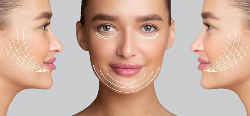 Yüz için İple Germe (Thread Lift): Cerrahi Olmayan Yüz Germe Çözümü